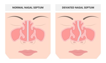 Formation Rhinologie : traitement des maladies du nez et des sinus